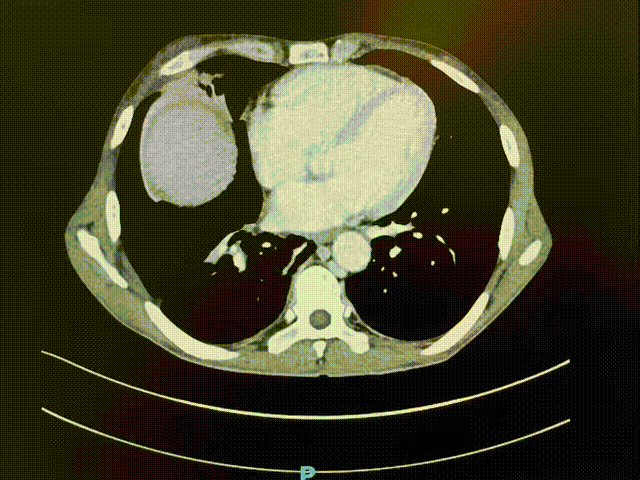 五斤肿瘤“霸占”腹腔,狭缝拆弹精准切除 五斤肿瘤“霸占”腹腔,狭缝拆弹精准切除