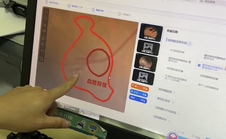 扬州市仪征：人工智能+眼底一张网，守护群众眼健康