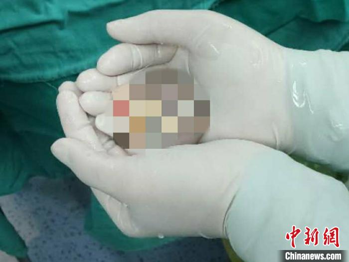 广西2岁幼儿捐献肾脏 2名尿毒症患者“重获新生”