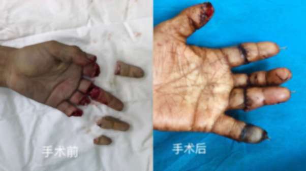 工友4根手指被切断11小时，广东医生显微镜下全部“接活”