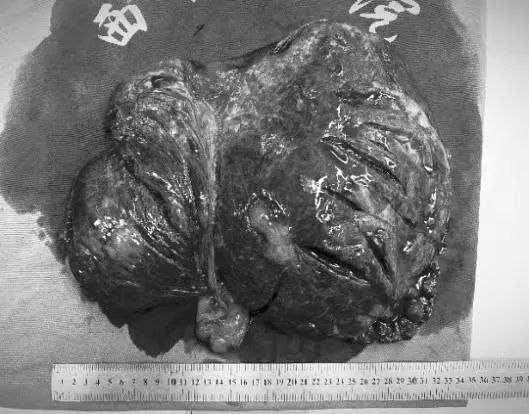 26斤！“抽丝剥茧”摘除罕见肝脏特大血管瘤