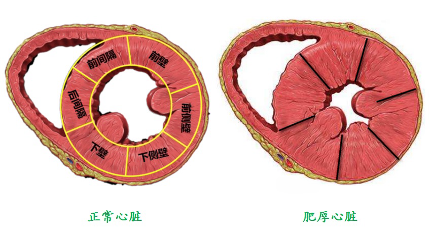 无需开刀！“一针”消融肥心病