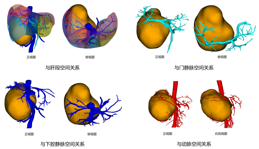 五斤肿瘤“霸占”腹腔，狭缝拆弹精准切除