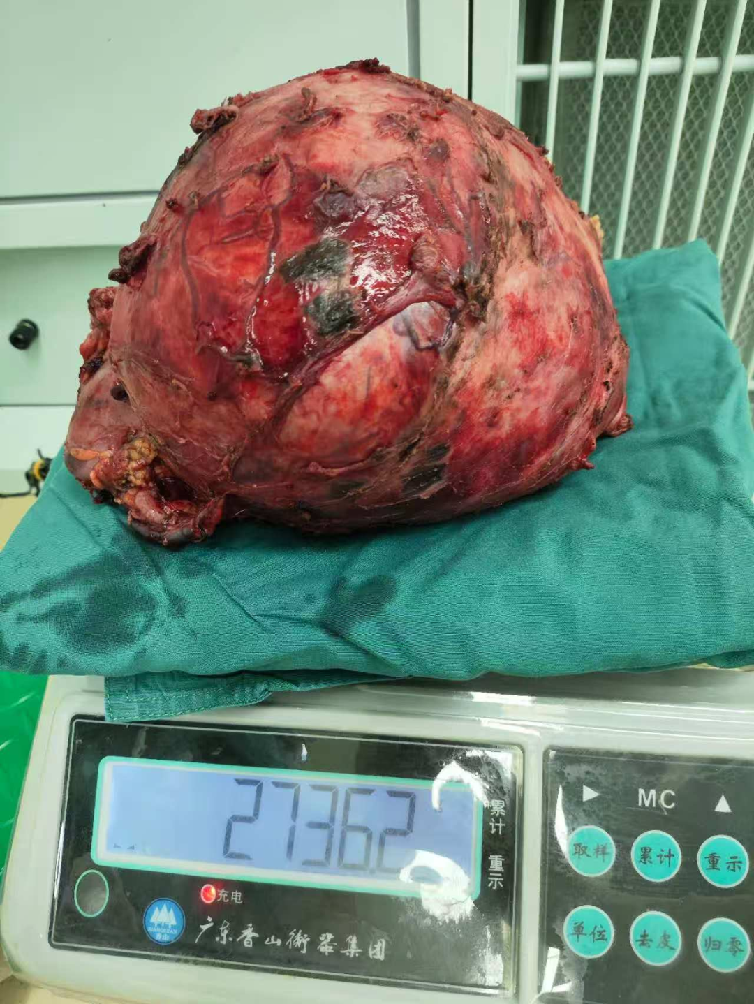 五斤肿瘤“霸占”腹腔，狭缝拆弹精准切除