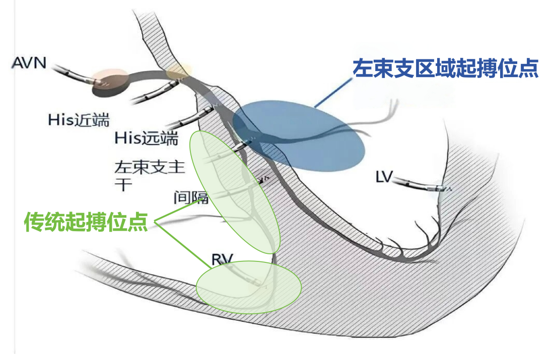 迈入生理性起搏新时代 江津医院微创手术救治高龄心衰患者